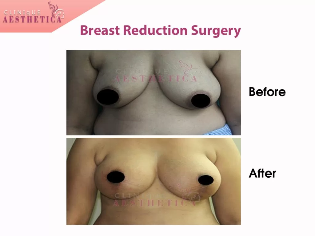 breast reduction before and after procedure real time image