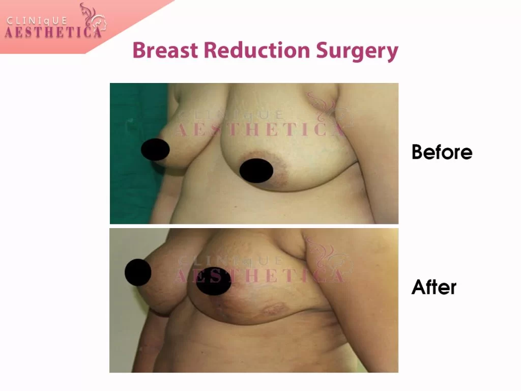 breast reduction before and after procedure real time image