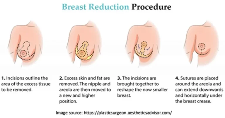 breast reduction procedure