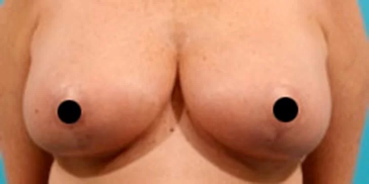 breast reduction before procedure real time image