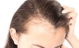 Regrowth After Traction Alopecia