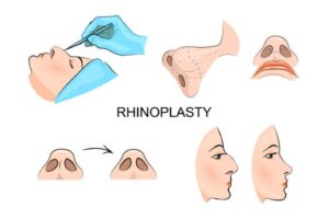 Benefits of Rhinoplasty after 20 years 