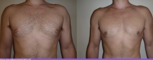 male nipple reduction 