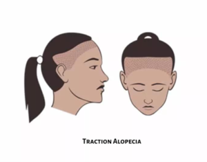 signs of permanent traction alopecia