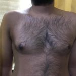 man boobs before procedure image