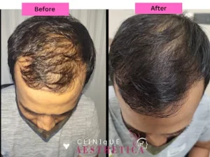 before and after hair transplant