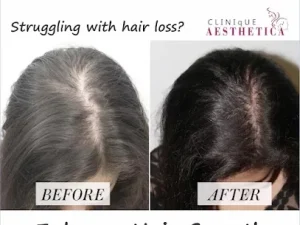 hair loss treatment before and after image for women