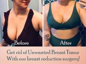 breast reduction surgery before and after images