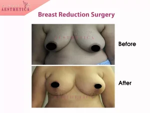 breast reduction surgery before and after images