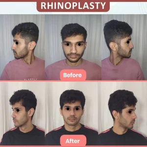 rhinoplasty before and after procedure image