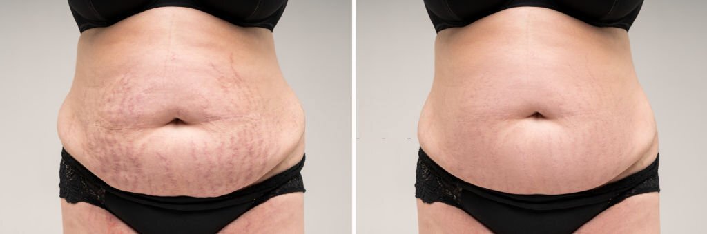 Before & After Lipo after tummy tuck