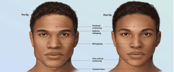 facial-feminization-surgery