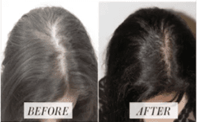 before and after female hair loss treatment