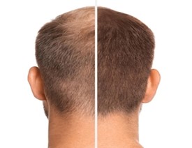 hair loss treatment before and after real time
