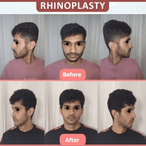 Rhinoplasty Surgery in Mumbai - Dr. Vinod Vij