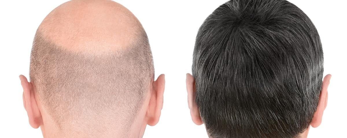 Before & After - Hair Transplant after 20 Years | Dr. Vinod Vij