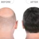 Before & After - Hair Transplant after 20 Years | Dr. Vinod Vij