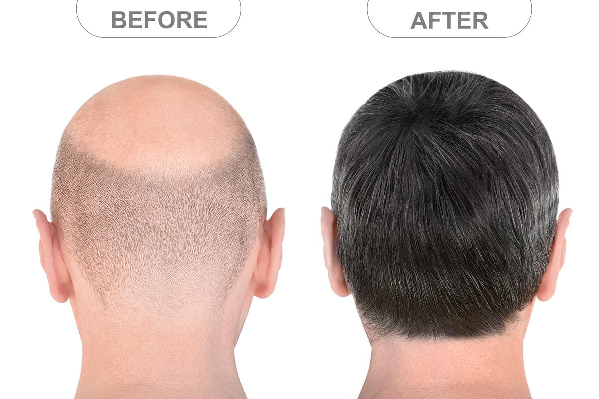 Hair Transplant after 20 Years: Assessing the Long Term Impact