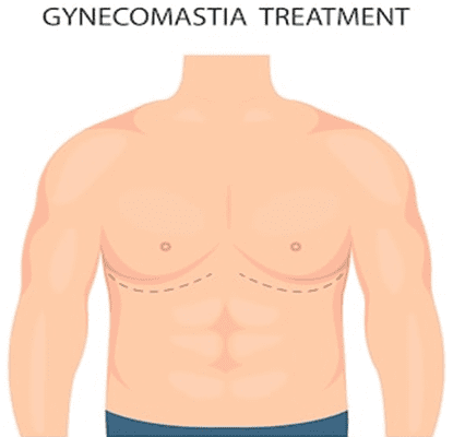 gynecomastia treatment