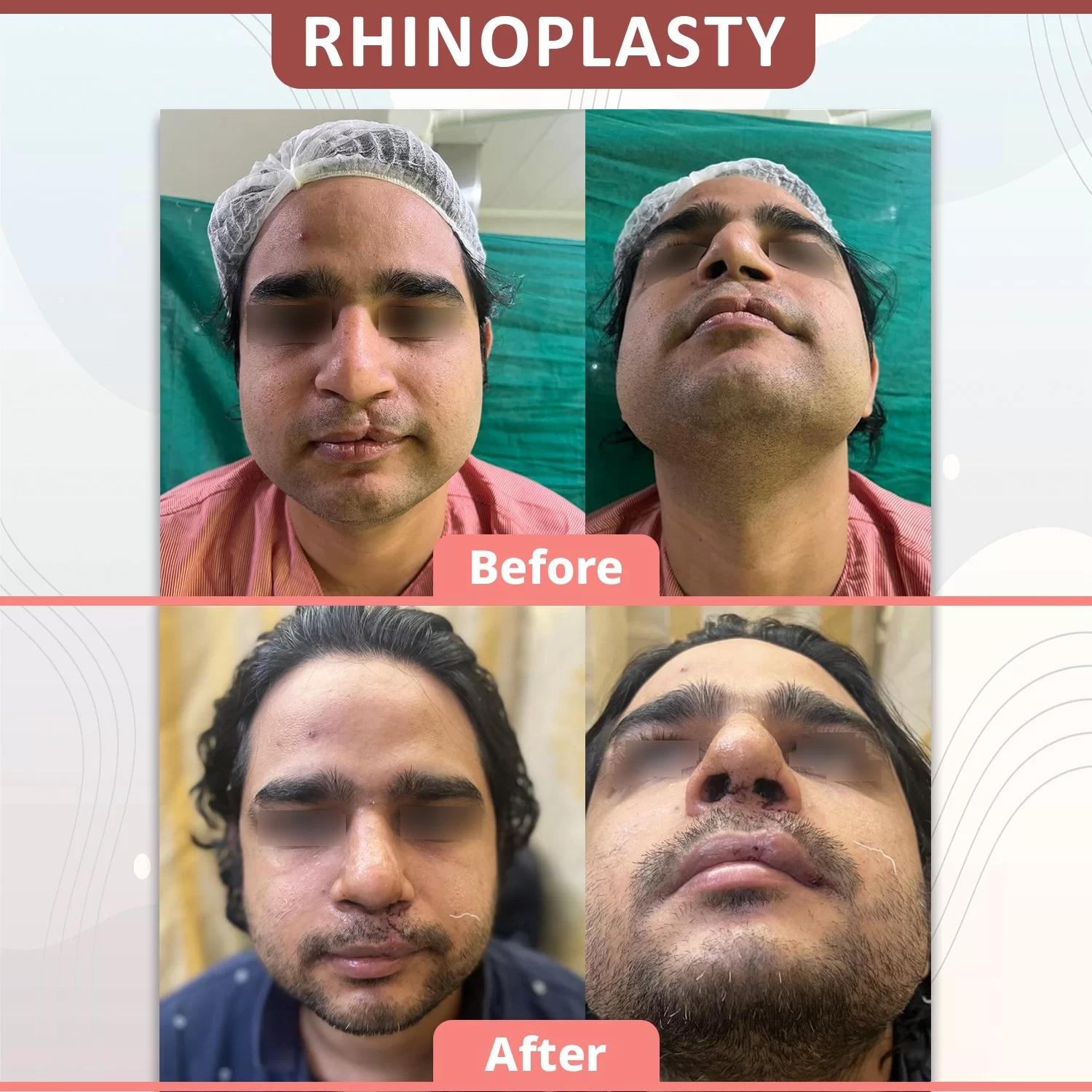 Rhinoplasty Treatment Before & After Images - Dr. Vinod Vij