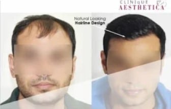 before and after procedure of hair transplant