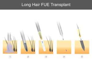Long hair FUE hair transplant