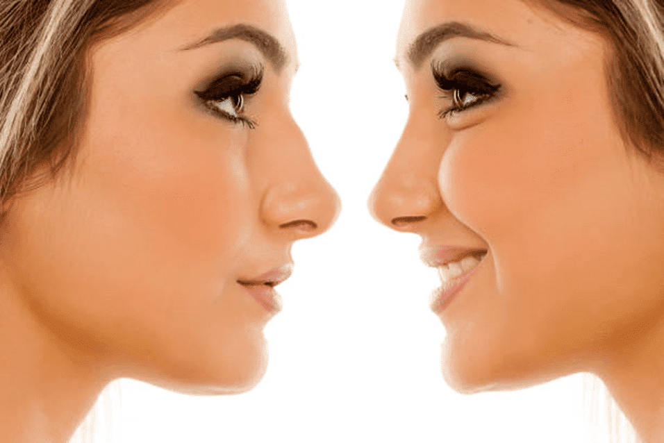 Silicone Rhinoplasty 