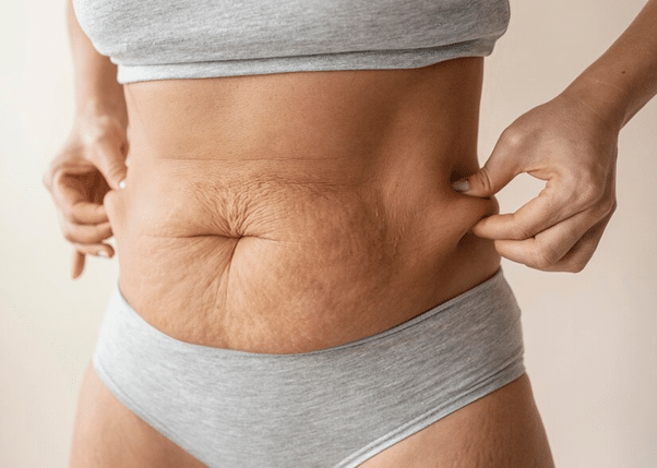 Post op guidelines 3 weeks after tummy tuck