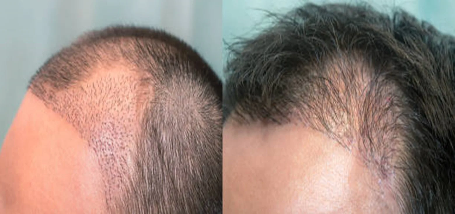 Hair Transplant