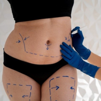 Liposuction