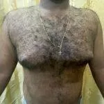 Success Rates Of Our Gynecomastia Surgery In Mumbai