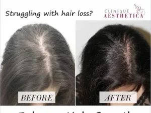 before/after hair loss treatment