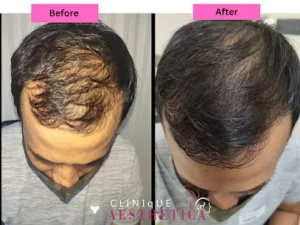 before/after hair loss treatment