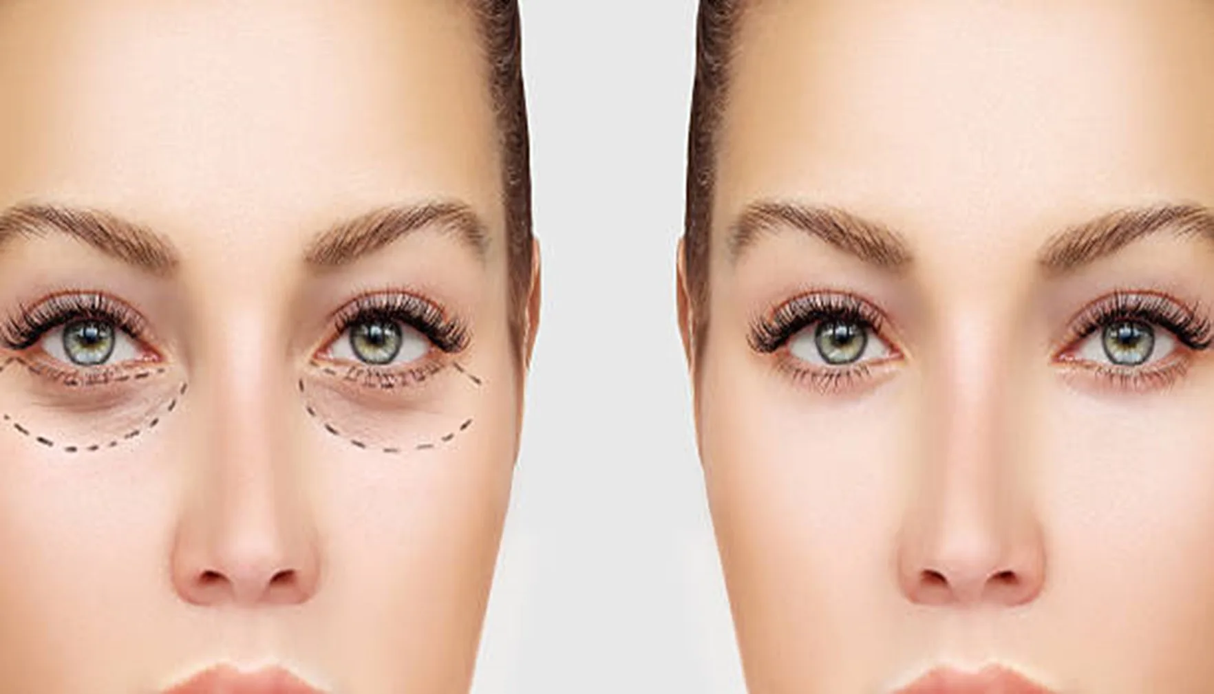 Blepharoplasty / Eyelid Surgery