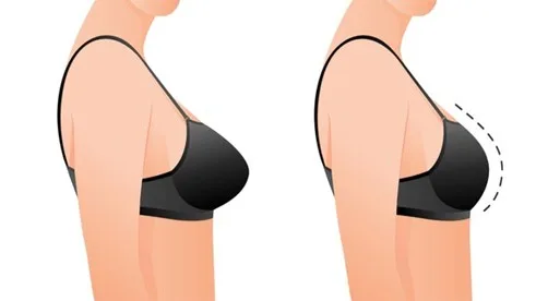 Breast Reduction: