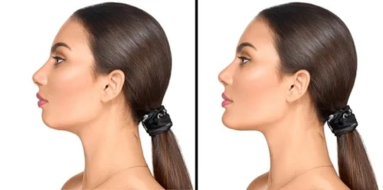 Chin-implants: