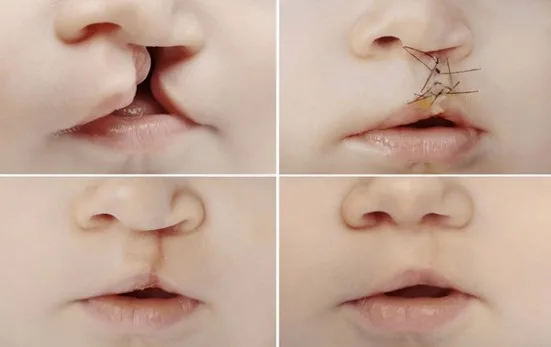 Cleft-lip Surgery: