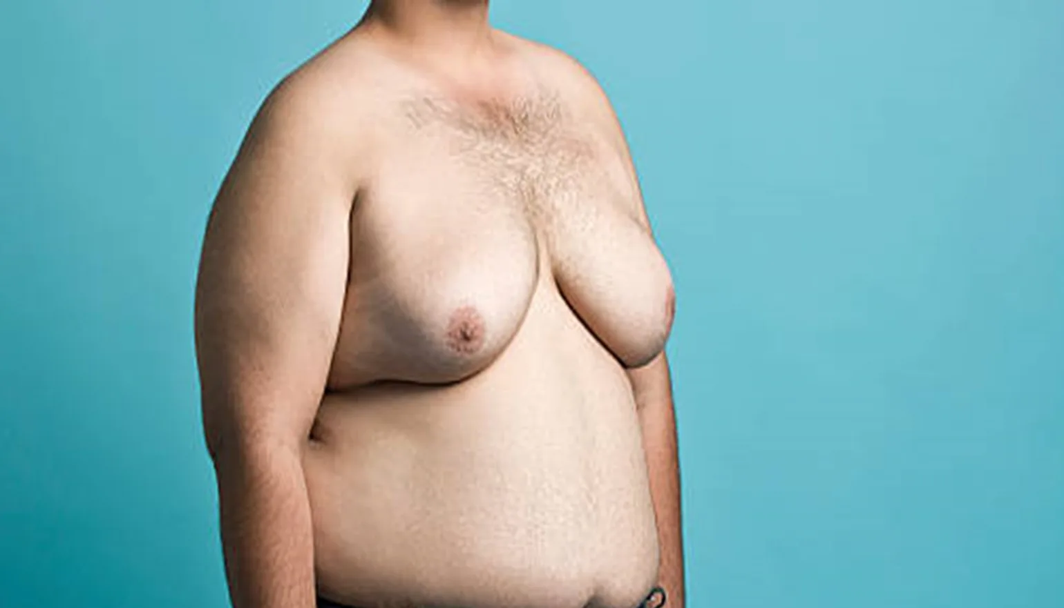 Gynecomastia Surgery: