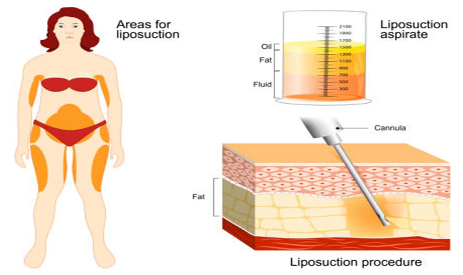 Liposuction