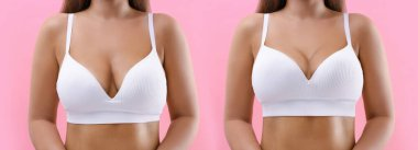 Dr. Vij for breast lift