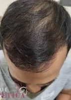 Hair transplant before after