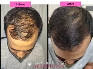 Hair transplant before after