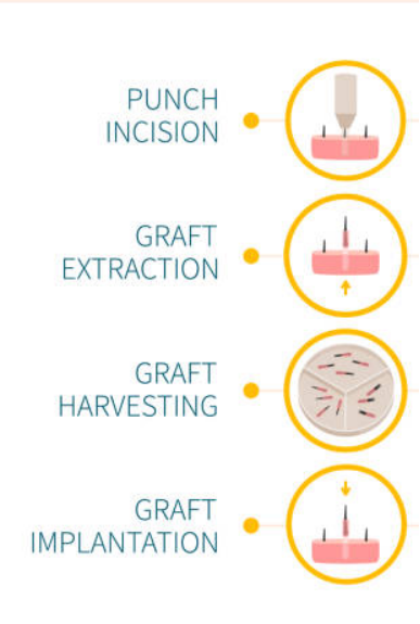 beard transplant procedure