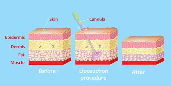 Liposuction