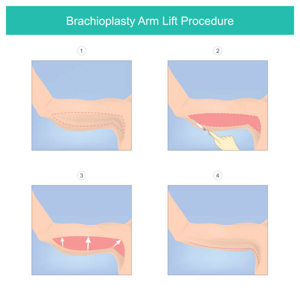 Our Arm Lift Procedure and Techniques