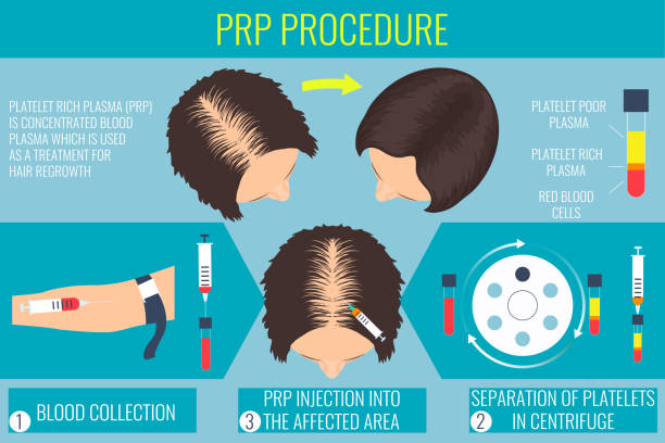 prp procedure