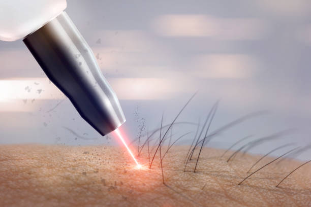 Types of Laser Hair Removal