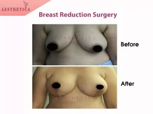 breast reduction surgery