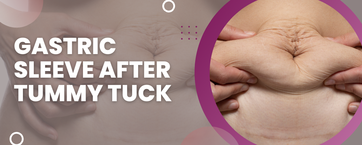 Gastric Sleeve After Tummy Tuck