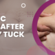 Gastric Sleeve After Tummy Tuck